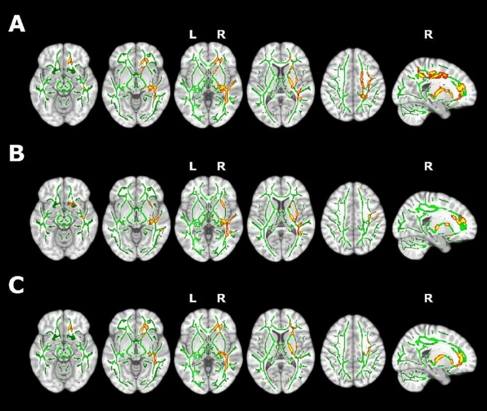 Foundation Pasqual Maragall Advances in Alzheimer’s Treatment with New Pharmaceutical Development